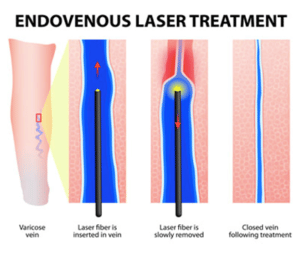Endovenous Laser Therapy