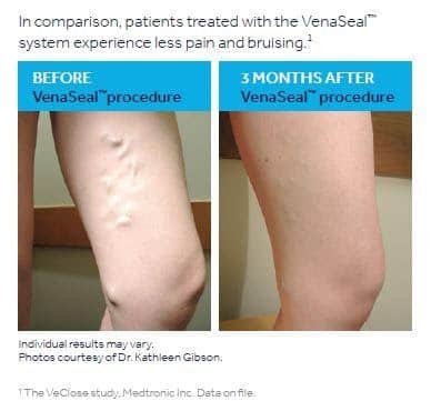 Varicose Veins Before/After Image