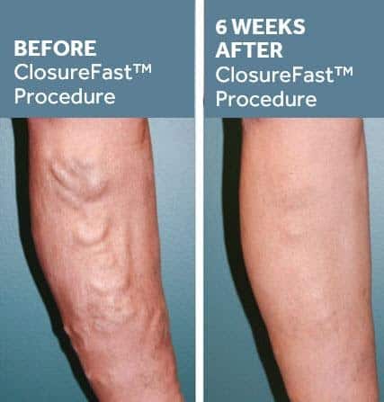 Varicose Veins Before/After Photo