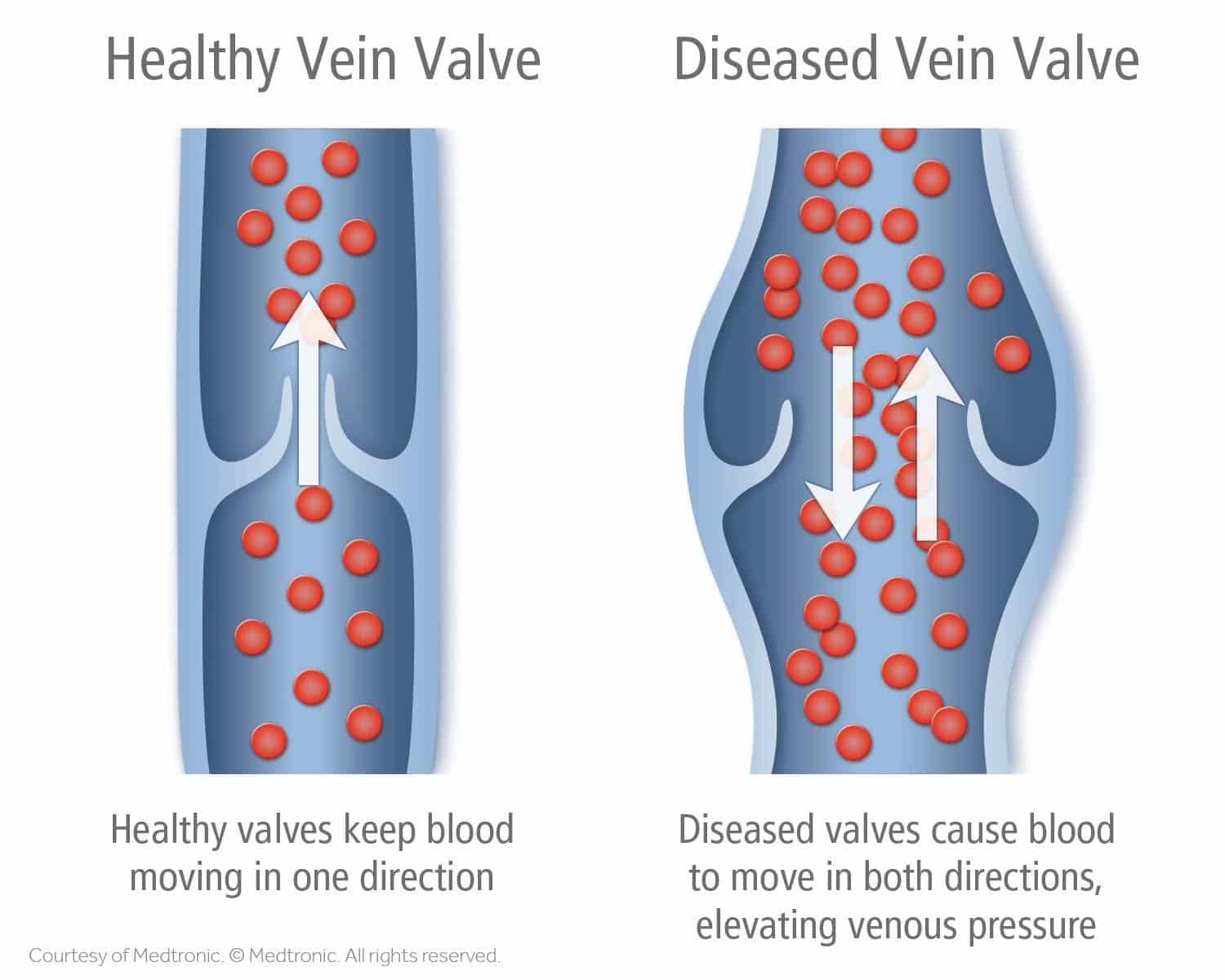 Difference Between Healthy Vein Valve and Diseased Vein Valve
