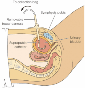 Medical diagram of Suprapubic Catheter Placement