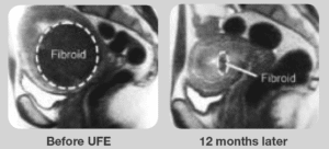 Xray of a Uterine Fibroid before and after uterine fibroid embolization
