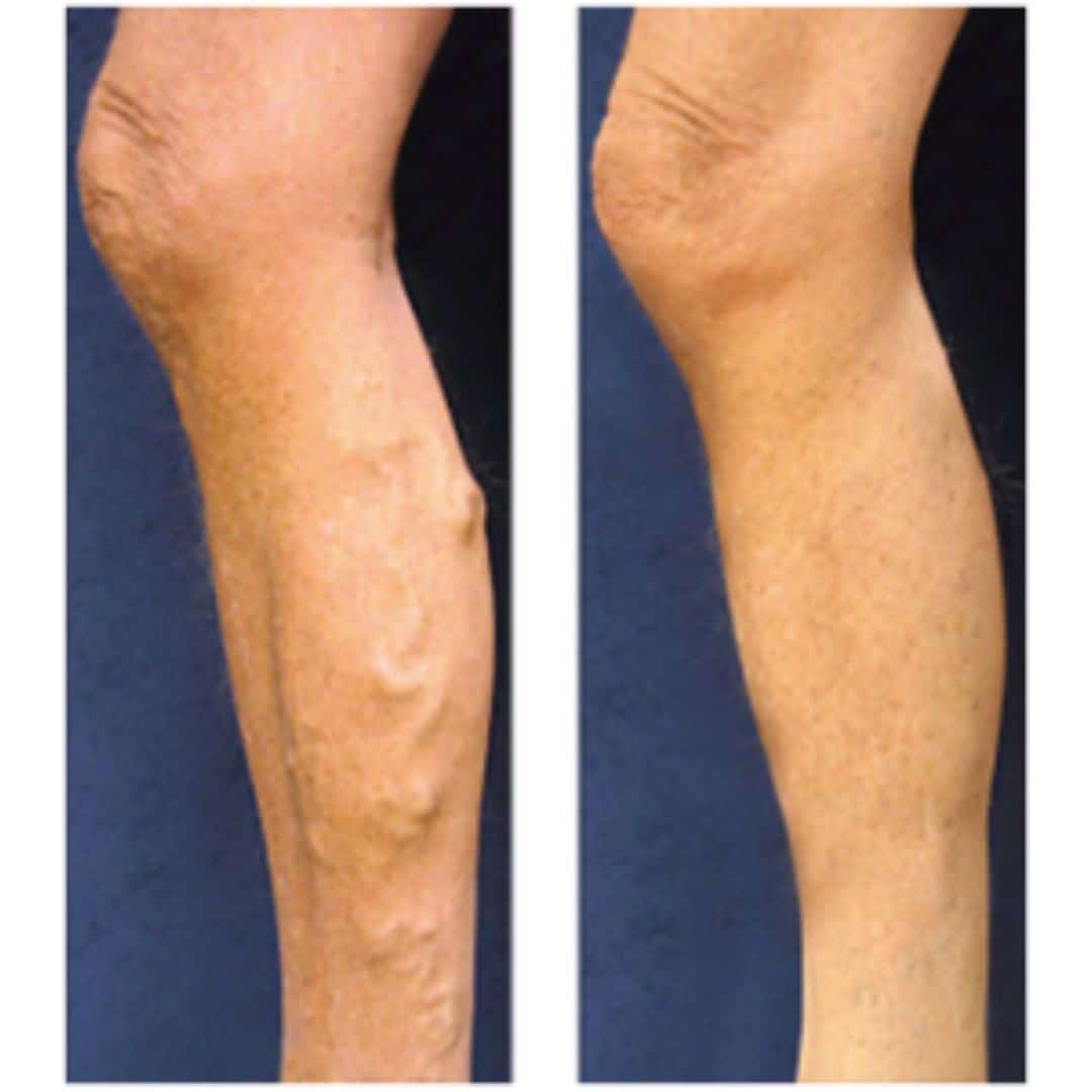 patient's leg before and after chronic venous insufficiency treatment, vein no longer visible after treatment