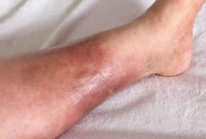 womans leg is shown swelling pain redness