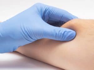 Doctor dermatologist examines the subcutaneous when on the patients arm