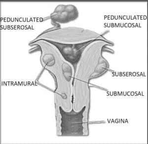 illustrated cross section of vagina with Uterine Fibroid Embolization, fibroids labeled throughout