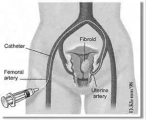 illustration of vagina and veins with catheter inserted for Uterine Fibroid Embolization