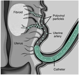 illustration of vagina and veins with catheter inserted for Uterine Fibroid Embolization with uterus labeled