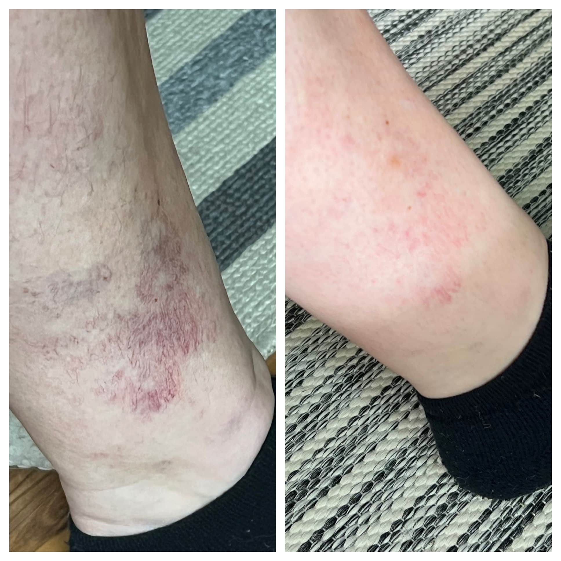 spider veins on lower leg before and after treatment