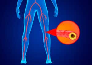 Peripheral arterial disease is the accumulation of fat and calcium in the walls of the arteries of the lower limbs preventing blood flow