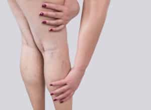 Woman with spider veins on legs in Fredericksburg, VA